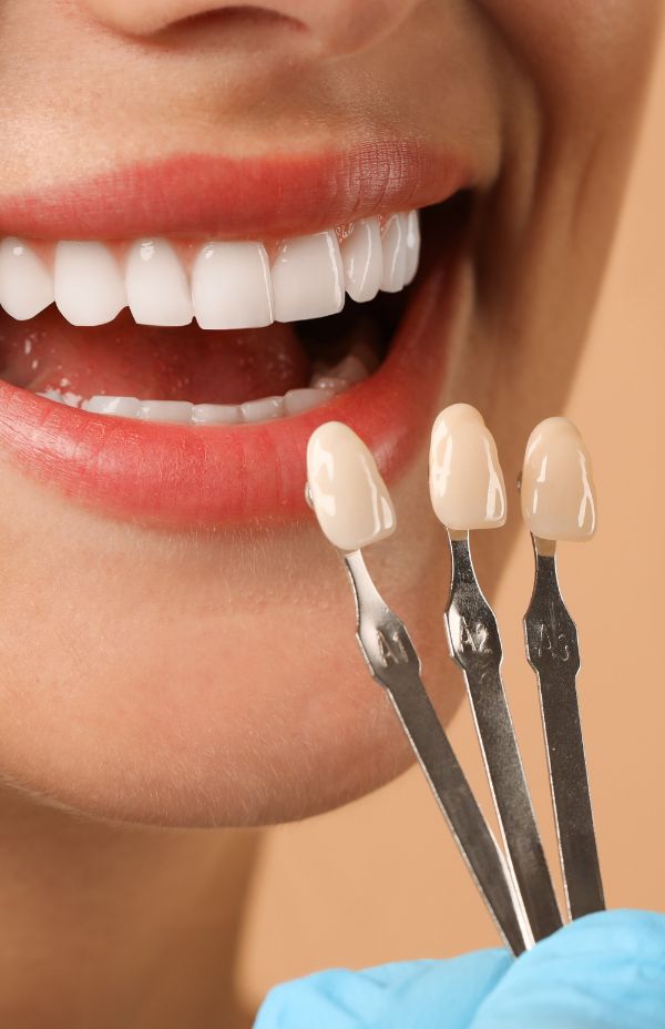 Veneers