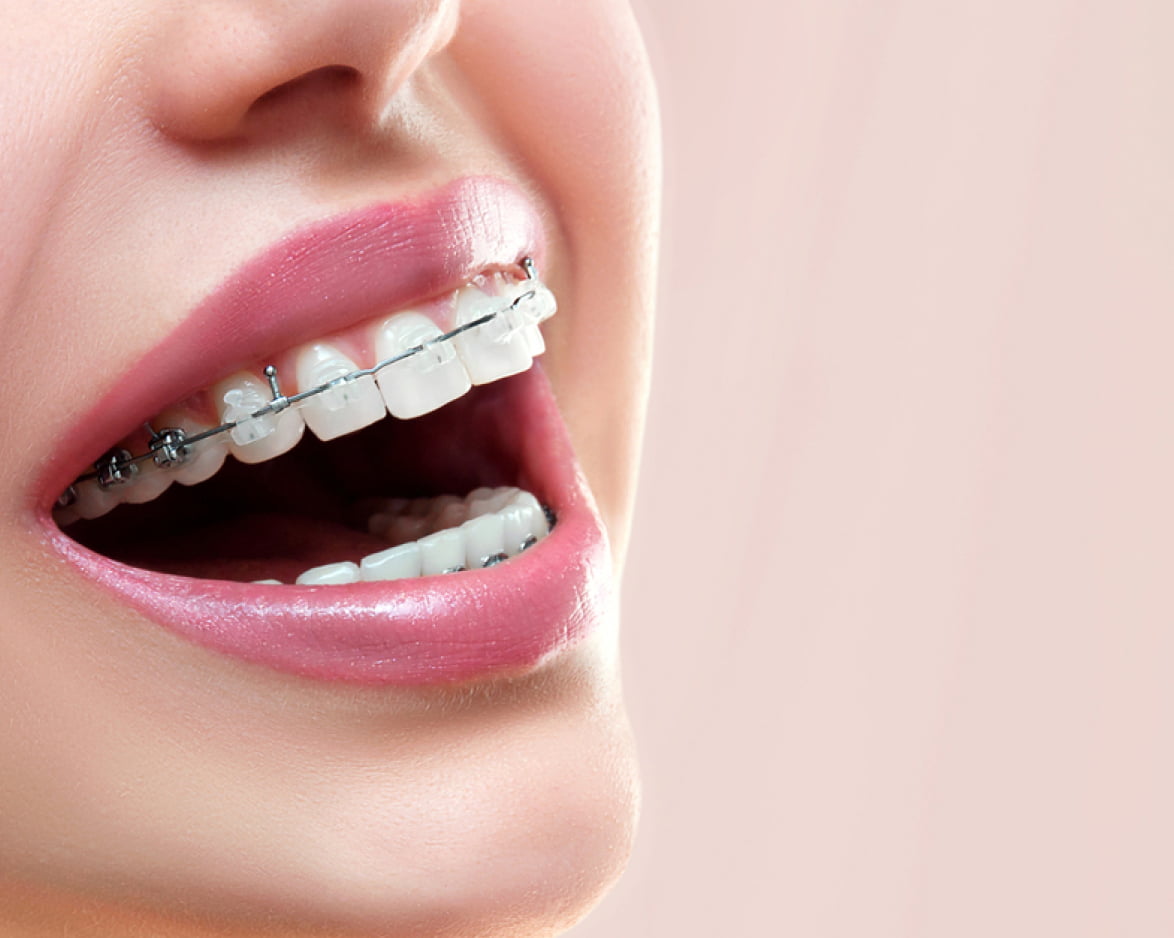 invisalign-braces