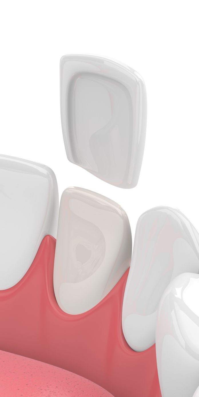 what is a veneer