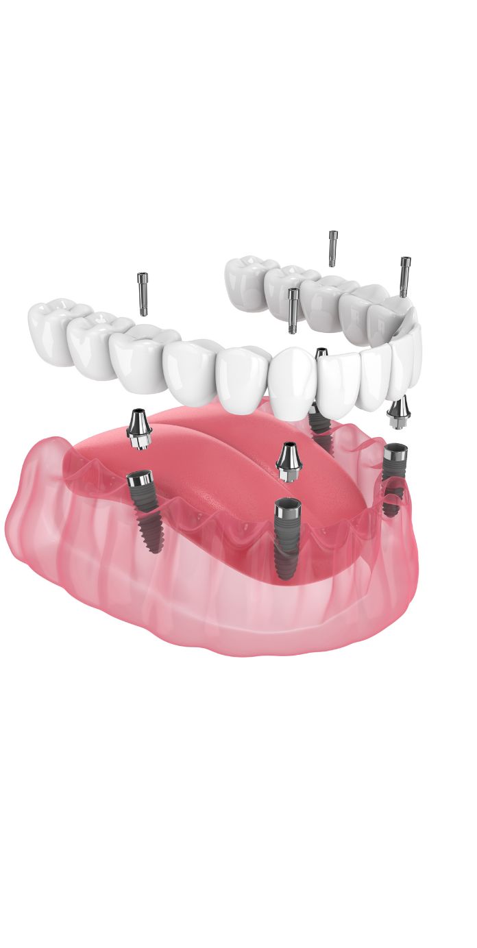 All-on-4 dental implants