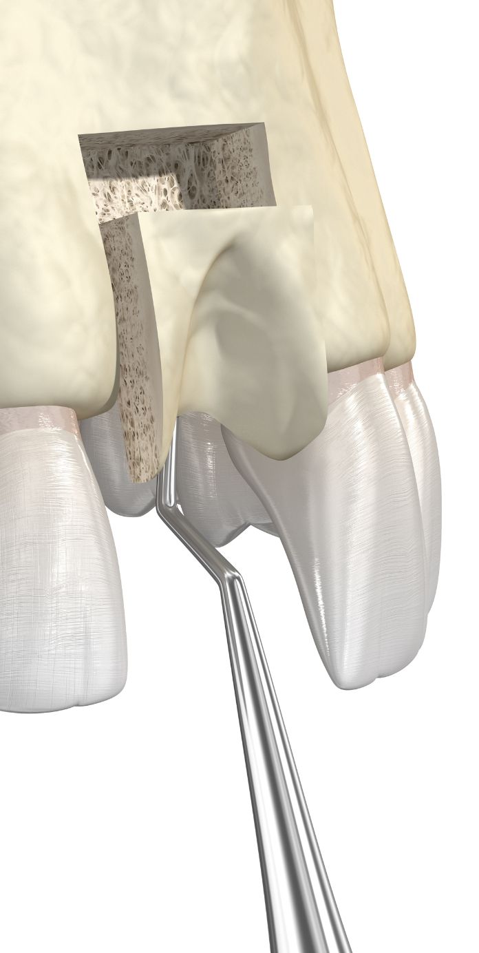 Bone graft