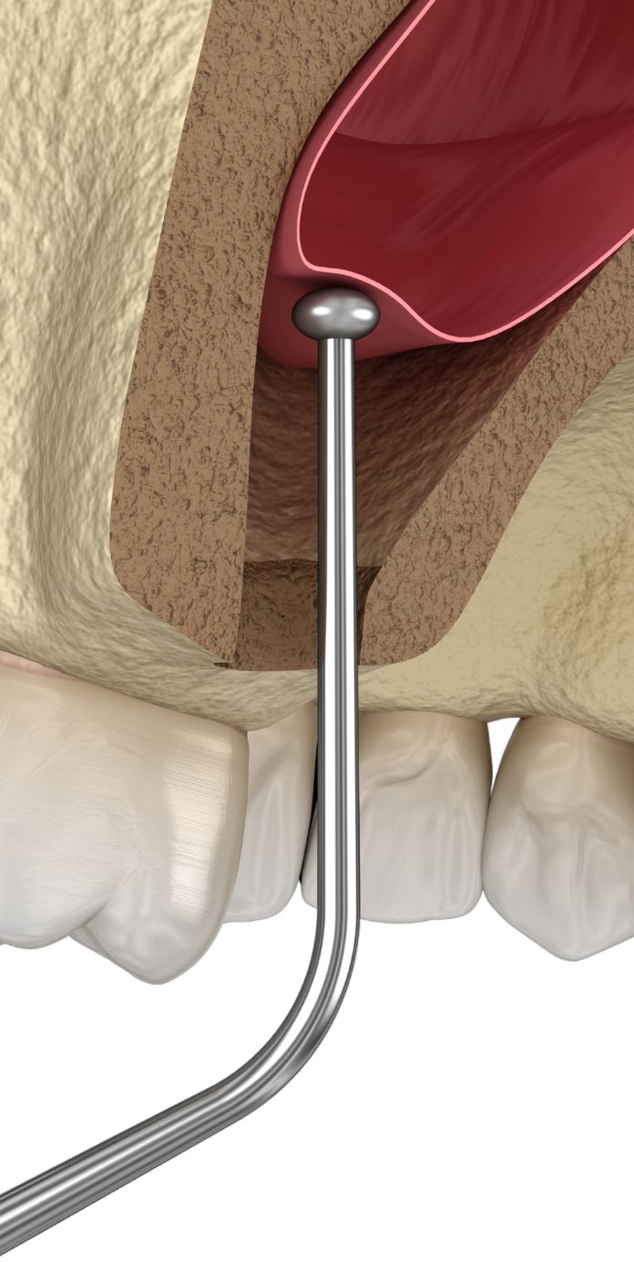Sinus lift
