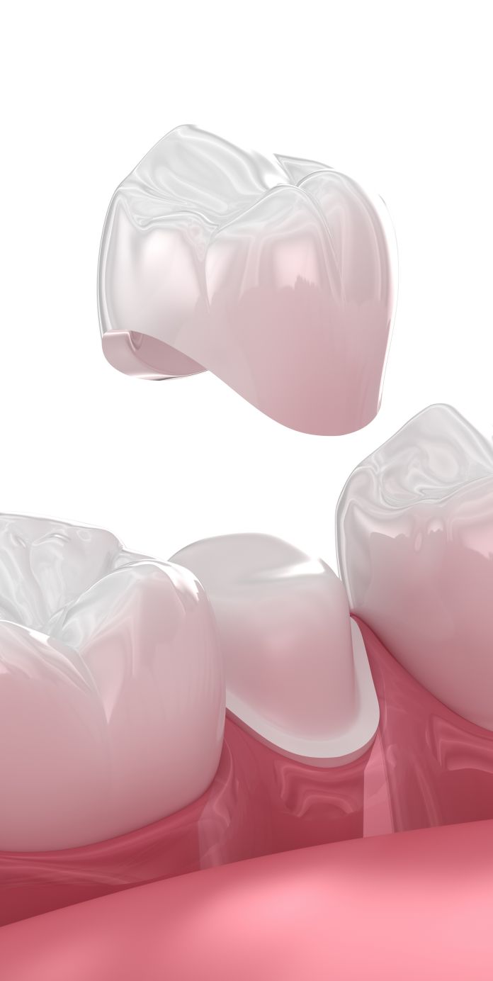 What is a dental crown