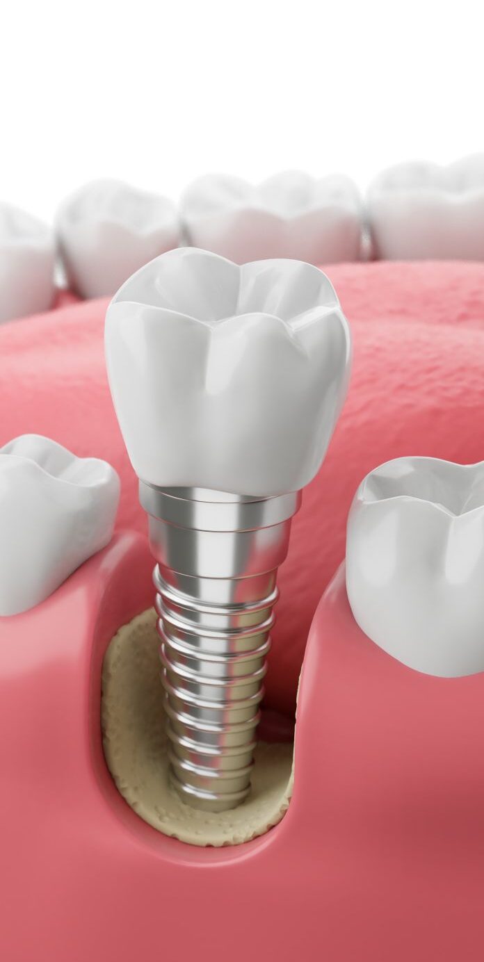 What is a dental implant
