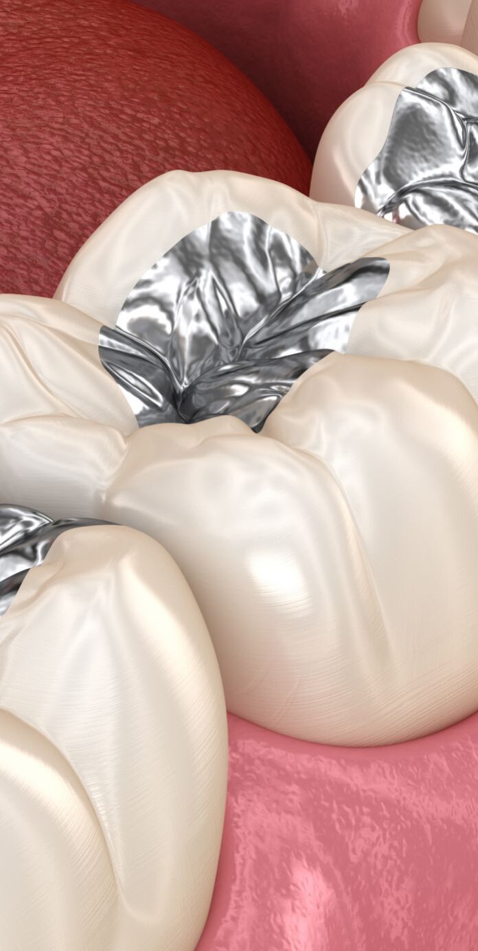 amalgam filling