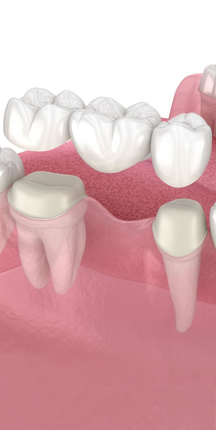 dental-bridge-new