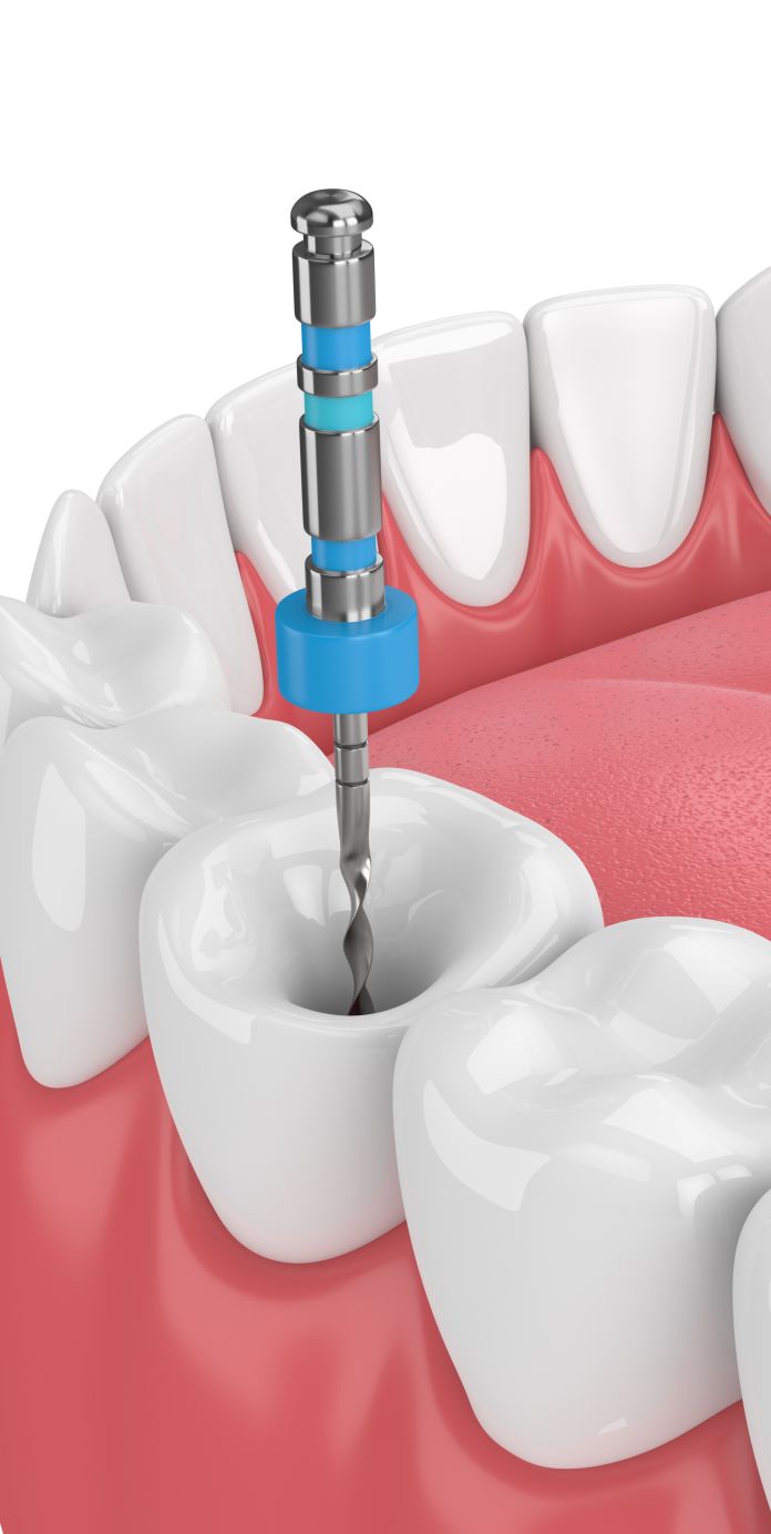 root canal treatment
