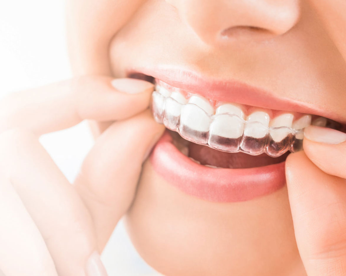 invisalign-aligner