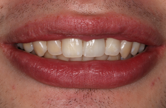 Implants_ Christopher after