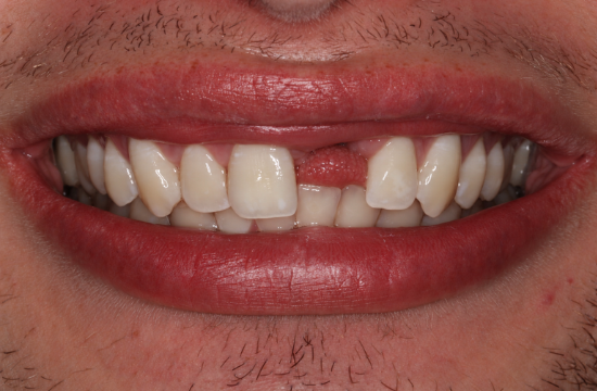 Implants_ Christopher before