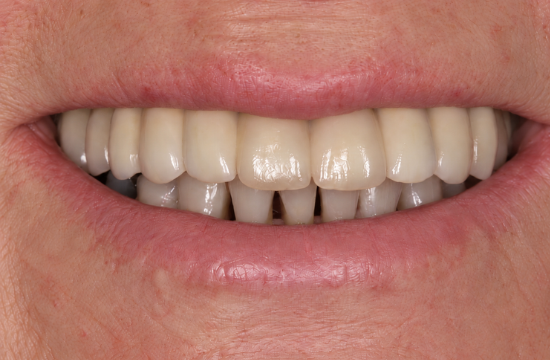 Implants_ Iris a