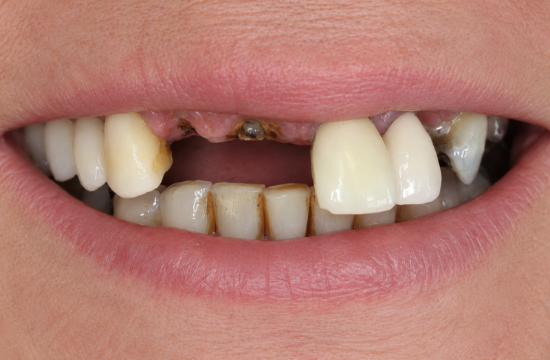 Implants_ Iris before