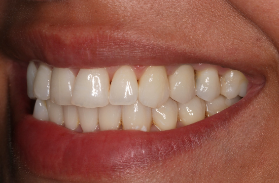 Implants_ Nancy a