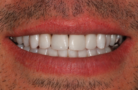 Smile Makeover Bruno a