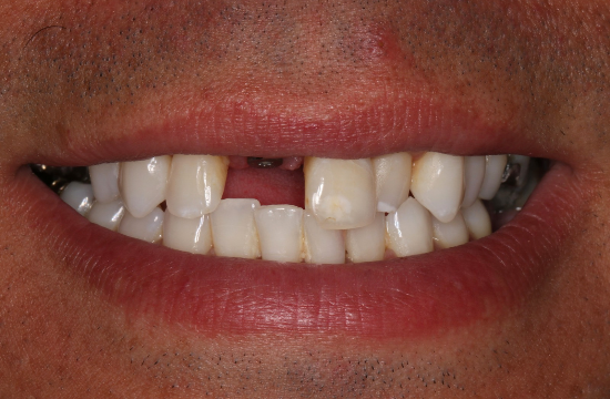Smile Makeover_ Bruno b