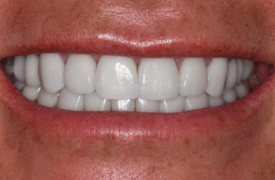 Smile Makeover_ Crystal a