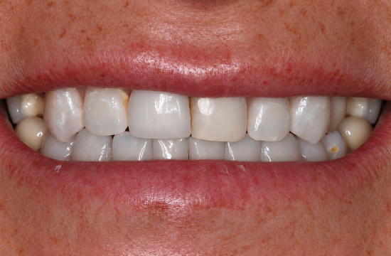 Smile Makeover_ Crystal b