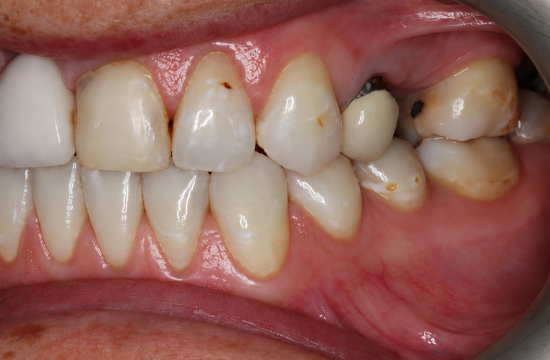 Smile Makeover_ Crystal left