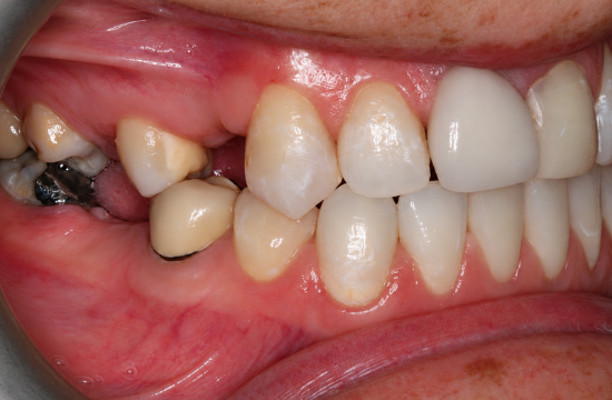 Smile Makeover_ Crystal right