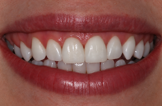 Smile Makeover_ Diana a