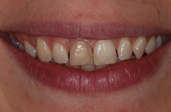 Smile Makeover_ Diana b