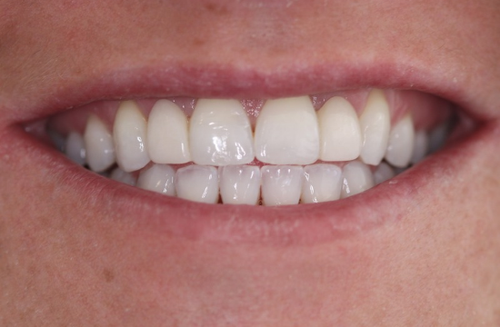 Smile Makeover_ Maria a