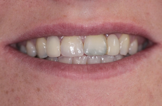 Smile Makeover_ Maria b