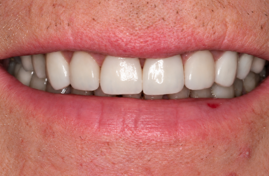 Smile Makeover_ Martyn a