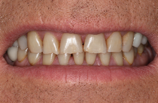 Smile Makeover_ Martyn b