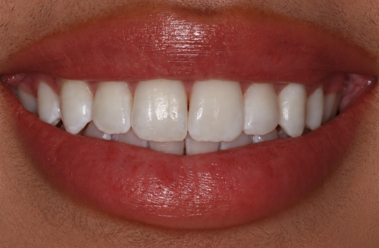 Teeth whitening_ Ayesha a