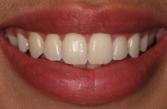 Teeth whitening_ Ayesha b
