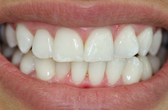 Teeth whitening_ Carla a