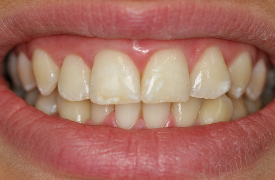 Teeth whitening_ Carla b
