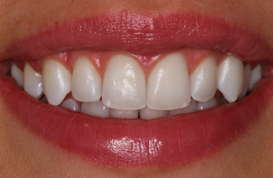 Teeth whitening_ Saskia a