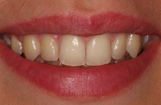 Teeth whitening_ Saskia b