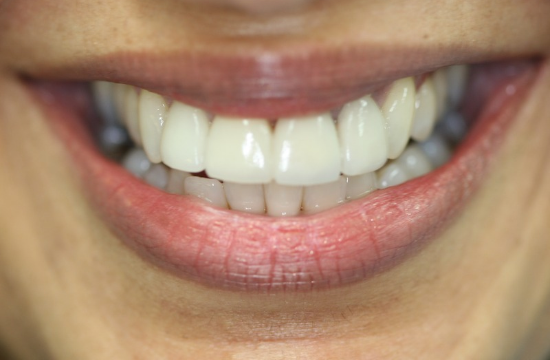 Veneers_ Chandna a
