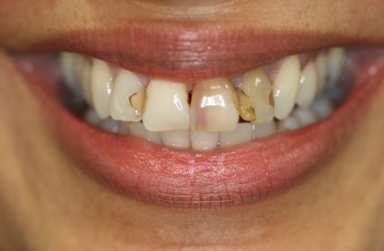 Veneers_ Chandna b