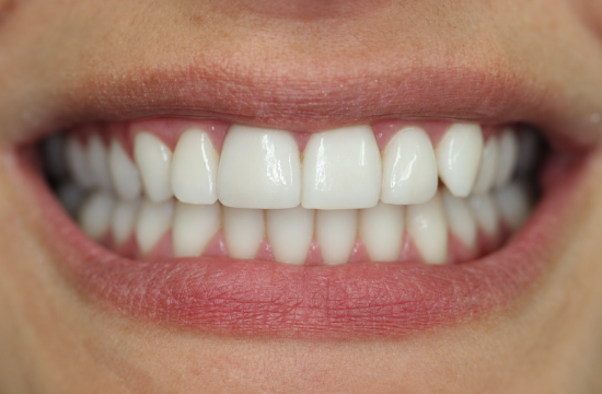 Veneers_ Claudia a