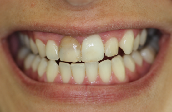 Veneers_ Claudia b