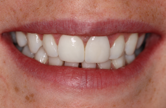 Veneers_ Jade a