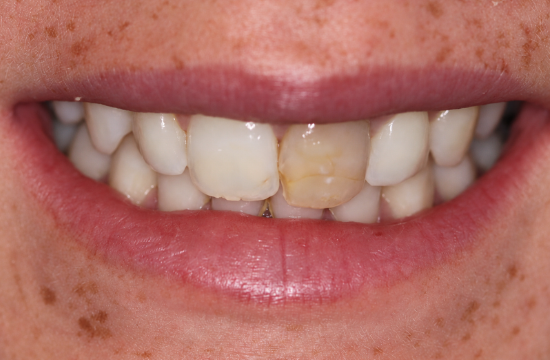 Veneers_ Jade b