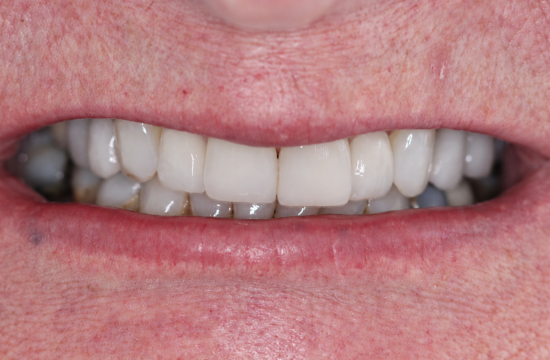 Veneers_ Jane a