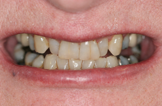 Veneers_ Jane b