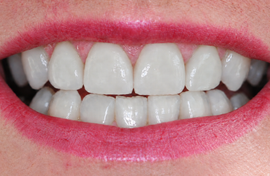 Veneers_ Jennifer a