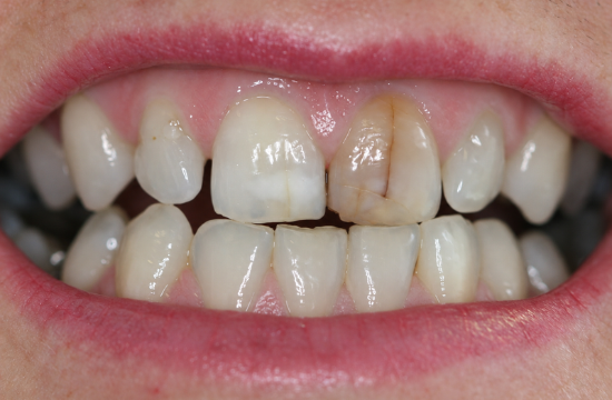 Veneers_ Jennifer b