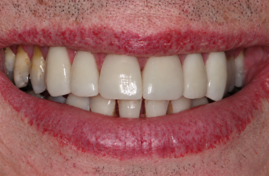 Veneers_ Malcolm a