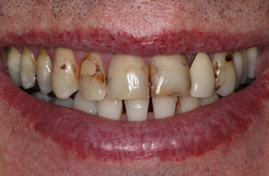 Veneers_ Malcolm b